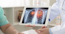 Amerikan Kanseri Derneği açıkladı akciğer kanserinde tarama yaşı düştü